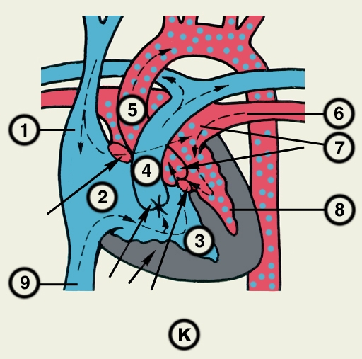 Рис. 23к). Схематическое изображение отдельных врожденных пороков сердца (направления кровотока обозначены пунктирными стрелками, локализация пороков — сплошными стрелками): пентада Фалло — стеноз легочного ствола, сочетающийся с декстропозицией аорты, дефектами межпредсердной, межжелудочковой перегородок и гипертрофией правого желудочка; 1 — верхняя полая вена, 2 — правое предсердие, 3 — правый желудочек, 4 — легочный ствол, 5 — аорта, 6 — легочная вена, 7 — левое предсердие, 8 — левый желудочек, 9 — нижняя полая вена