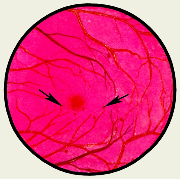 Рис. 14. Глазное дно в норме и при патологии. Диабетическая ангиоретинопатия: стрелками указаны микроаневризмы