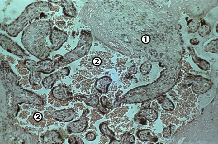 Рис. 3а). Микропрепарат участков плаценты с гемодинамическими нарушениями при доношенной беременности: кровоизлияния в межворсинчатое пространство (1 — ворсины плаценты разного калибра, 2 — скопления эритроцитов в межворсинчатом пространстве); ×100