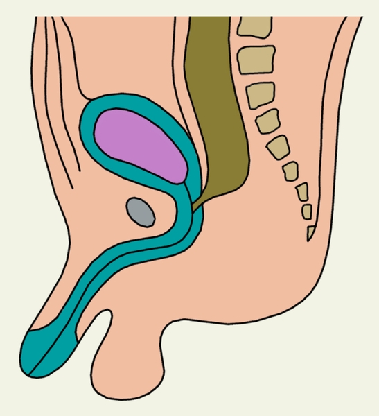 Рис. 2д). Схематическое изображение пороков развития прямой кишки и заднепроходного отверстия: атрезия прямой кишки со свищом в уретру
