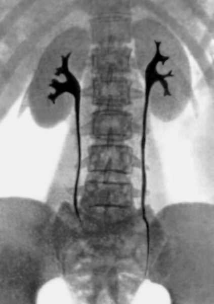 Рис. 1. Урограмма в норме: видны тени почек (левая <a href=