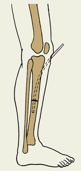 Рис. 4. Закрытый остеосинтез большеберцовой кости штифтом