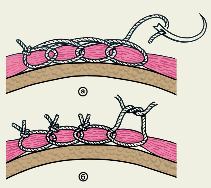 Рис. 9. Схематическое изображение вариантов гемостатических швов: а — непрерывный цепочный (обкалывающий) шов по Гейденгайну; б — узловой цепочный шов по Гейденгайну — Гаккеру