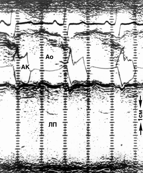 Рис. 11в). Эхокардиограмма в М-режиме больного с обструктивной гипертрофической кардиомиопатией (полости сердца — светлые поля, плотные структуры — темные): в просвете аорты эхосигналы от заслонок аортального клапана указывают на систолическое схождение заслонок (прикрытие), которое обусловлено высоким градиентом давления между выходным трактом левого желудочка и аортой