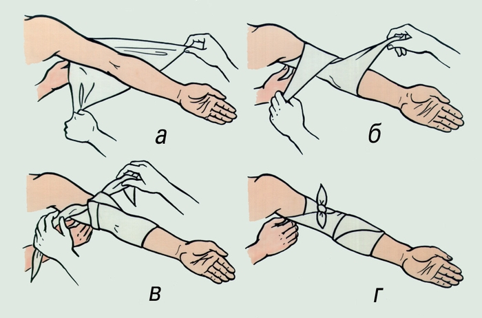 Рис. 5. Наложение косыночной повязки на локтевой сустав: а, б, в, г — этапы <a href=