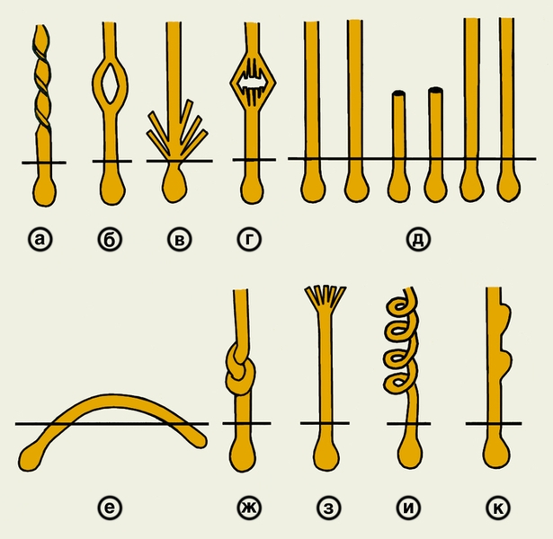 Рис. 2. Виды деформации волос (схематическое изображение): а — закрученный волос; б — раздваивающийся волос; в — пучкообразный волос; г — волос при узловатой трихоклазии; д — волосы при идиопатической трихоклазии; е — вросший волос; ж — волос при трихонодозе (петлеобразное закручивание); з — волос при трихоптилозе; и — волос при аллотрихии (спиралевидное закручивание); к — волос при бактериальном трихофолликулите (белесоватые узелки, напоминающие гниды)