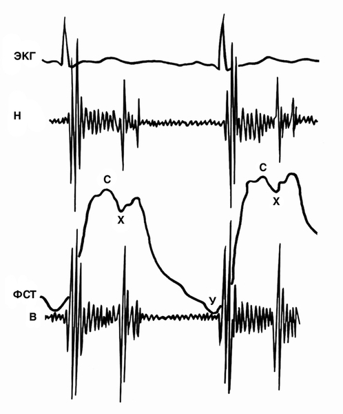 Рис. 19. Югулярная флебосфигмограмма (ФГС), зарегистрированная вместе с ЭКГ и ФКГ низких (Н) и высоких (В) частот у больного с трикуспидальной недостаточностью: систолический венный пульс (высокая волна с, почти отсутствует х-коллапс, у-спад развивается медленно); на ФКГ — голосистолический шум