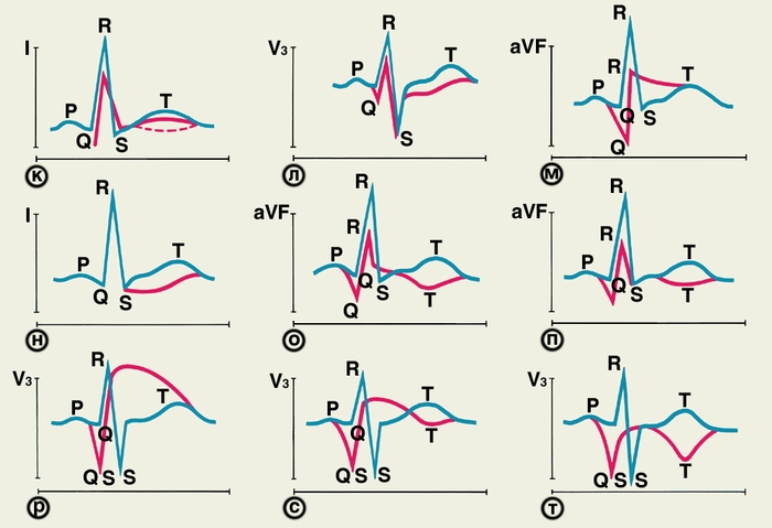 Рис. 9(к—т). Схематическое изображение изменений ЭКГ при стенокардии, очаговой дистрофии и инфаркте миокарда разной локализации (иллюстрации к табл. 1): синяя кривая — нормальная ЭКГ, красные кривые — патологически измененные ЭКГ