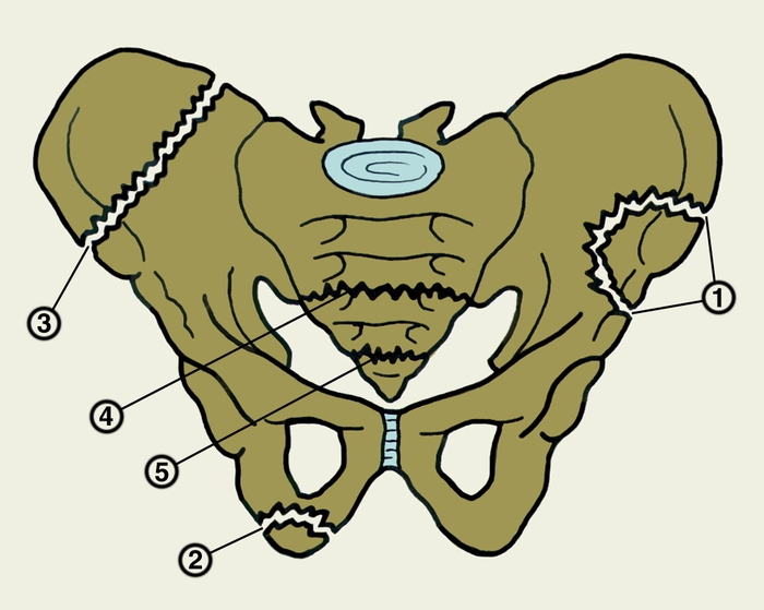 Рис. 4. Схематическое изображение краевых переломов таза: 1 — отрывной перелом верхней передней подвздошной ости; 2 — отрывной перелом седалищного бугра; 3 — перелом крыла подвздошной кости; 4 — перелом крестца ниже крестцово-подвздошного сочленения; 5 — перелом копчика