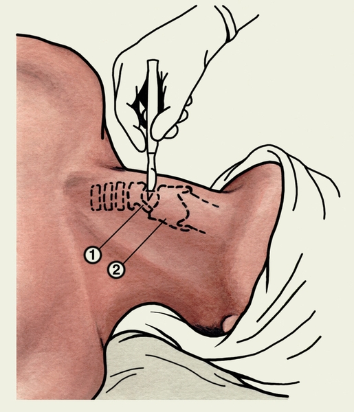 Рис. 1. Схема коникотомии: 1 — дуга перстневидного хряща; 2 — щитовидный <a href=