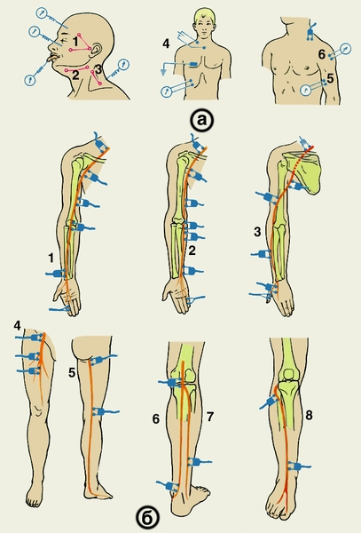 Рис. 3. Расположение отводящих и стимулирующих электродов: а — при исследовании скорости проведения импульса по лицевому (1), подъязычному (2), добавочному (3), диафрагмальному (4), мышечно-кожному (5), подмышечному (6) нервам; б — при стимуляции срединного нерва (1), локтевого нерва (2), лучевого нерва (3), бедренного нерва (4), седалищного нерва (5), большеберцового нерва (6), икроножного нерва (7), малоберцового нерва (8)
