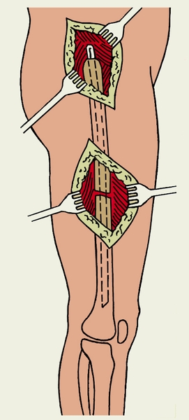 Рис. 3в). Открытый внутрикостный остеосинтез бедра: из центрального отломка штифт проведен в периферический