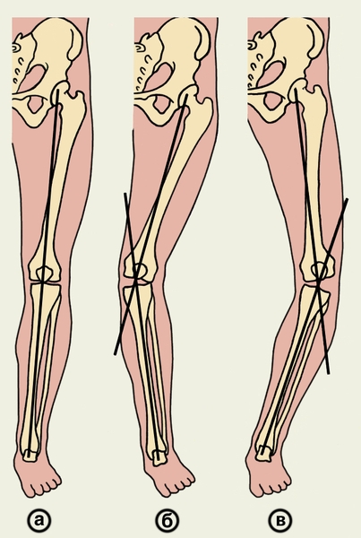 Рис. 9. Схематическое изображение оси нижней конечности: а — в норме; б — при genu valgum; в — при genu varum