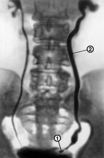 Рис. 7. Экскреторная урограмма при мочекаменной болезни: 1 — тень камня интрамурального отдела левого мочеточника; 2 — <a href=