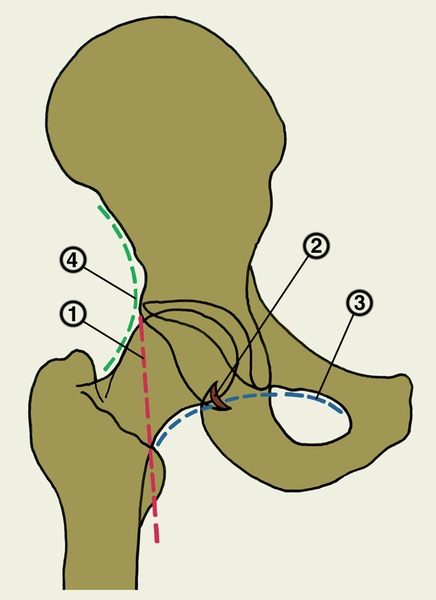 Рис. 4. Схема ориентиров нормальных анатомических взаимоотношений в тазобедренном суставе: 1 — линия (вертикаль) Омбреданна — перпендикуляр, опущенный от края вертлужной впадины; 2 — «фигура полумесяца» пересекает контур головки бедренной кости; 3 — линия (дуга) Шентона проведена по медиальному контуру шейки бедренной кости и плавно продолжается вдоль нижнего края горизонтальной ветви лобковой кости; 4 — линия (дуга) Кальве