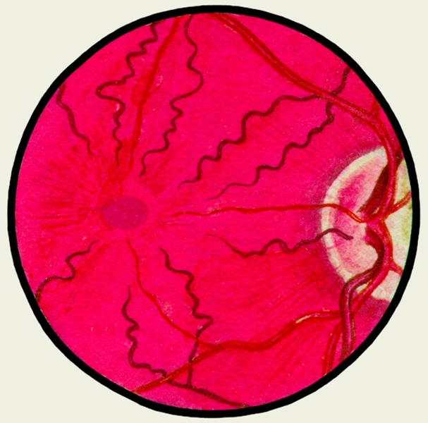 Рис. 7. Глазное дно в норме и при патологии. Гипертоническая <a href=